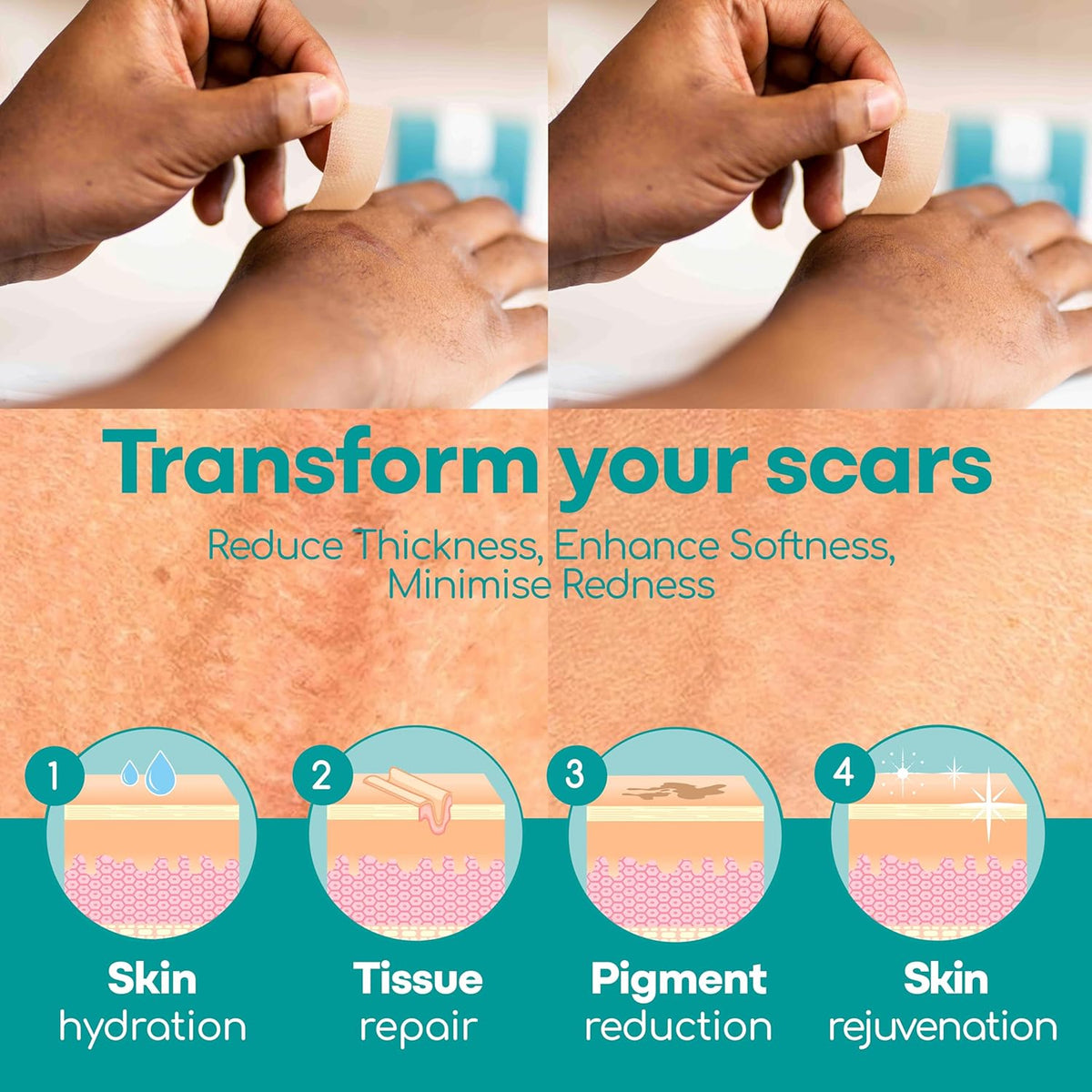 Silicone Scar Sheets, 80 Inches Long - Reusable Silicone Scar Tape - Includes Hygienic Storage Case D70791